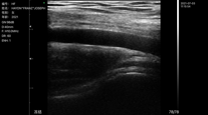 Wireless Ultrasound for Arteria Axilar C