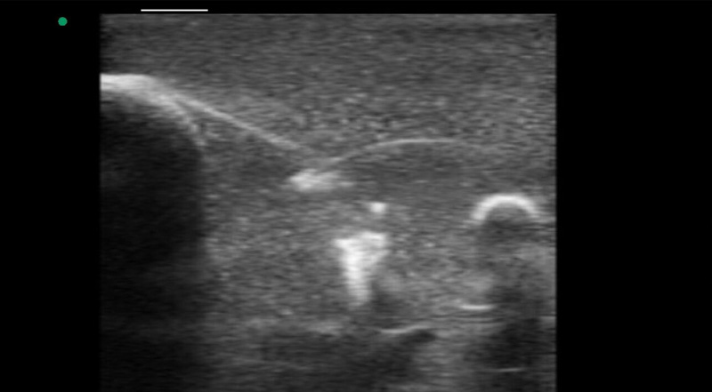 Wireless Ultrasound for Entrenamiento de biopsia mamaria
