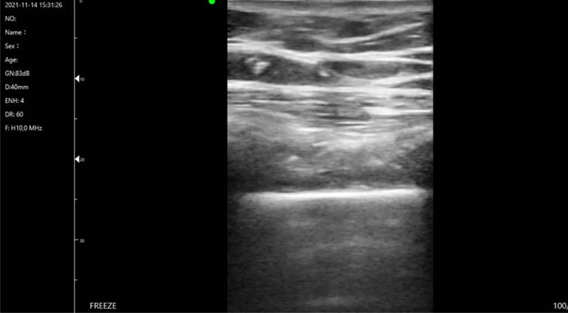 Wireless Ultrasound for Pulmón C10T