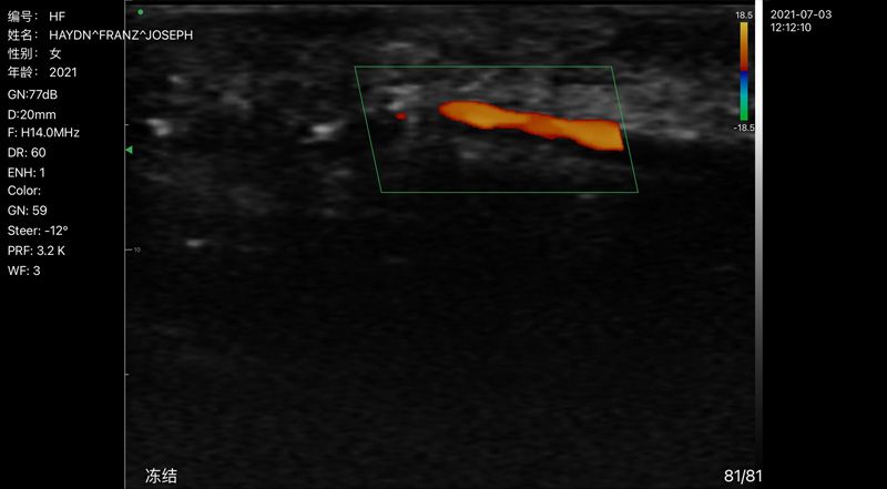Wireless Ultrasound for Arteria del dedo
