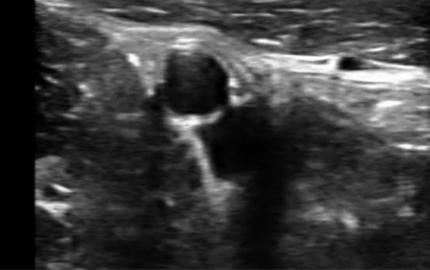 Arteria Ilíac B Transductor de ultrasonido abdominal