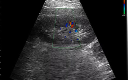 Sonda abdominal Ultrasonido renal C