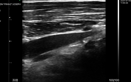 Sonda de ultrasonido abdominal Hígado B