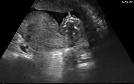 Cuerpo entero abdomen ultrasonido fetal B